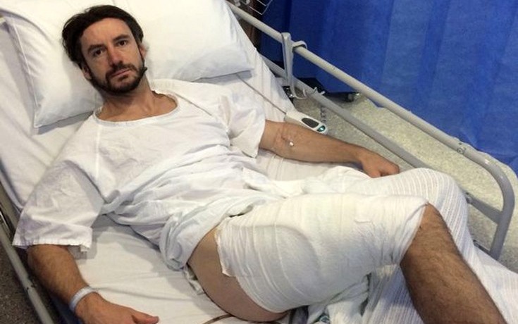 Βρετανός ποδηλάτης δείχνει πώς έγινε το πόδι του μετά από «έκρηξη» iPhone