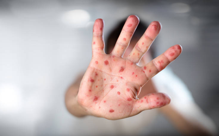 Συναγερμός στη Βρετανία από την αύξηση των κρουσμάτων ιλαράς