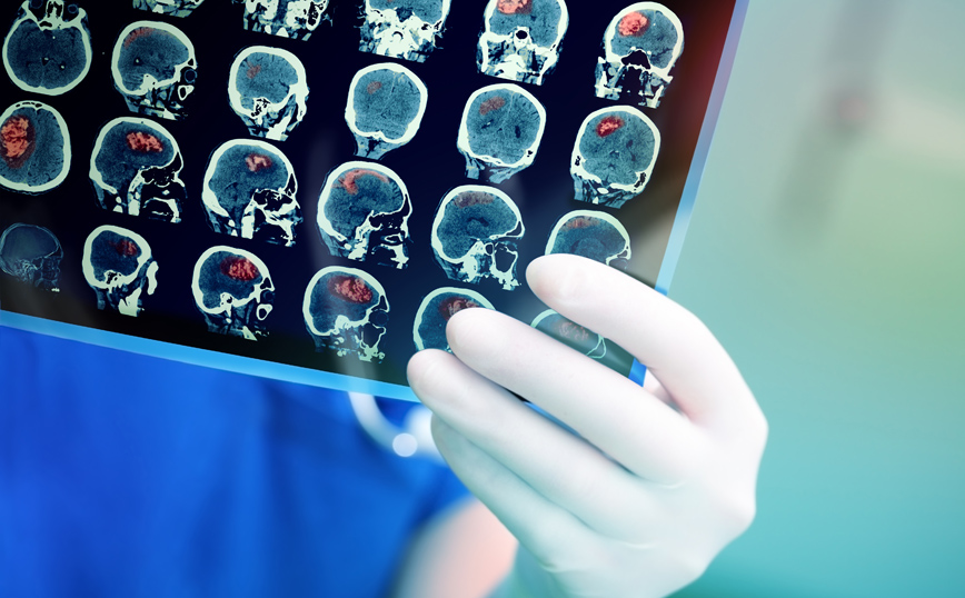 Κορονοϊός &#8211; «Καμπανάκι» από τους επιστήμονες: Η βαριά λοίμωξη μπορεί να προκαλέσει νευρολογικά προβλήματα στον εγκέφαλο
