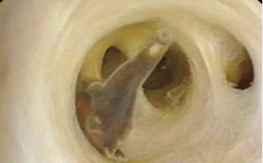 Ανατριχιαστικές εικόνες σε ιατρικό περιοδικό: Σκουλήκια στριφογυρίζουν στην κοιλιά ενός άντρα
