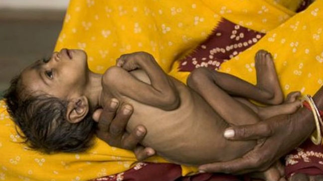 Αντιμέτωπα με υποσιτισμό 1 εκατ. παιδιά