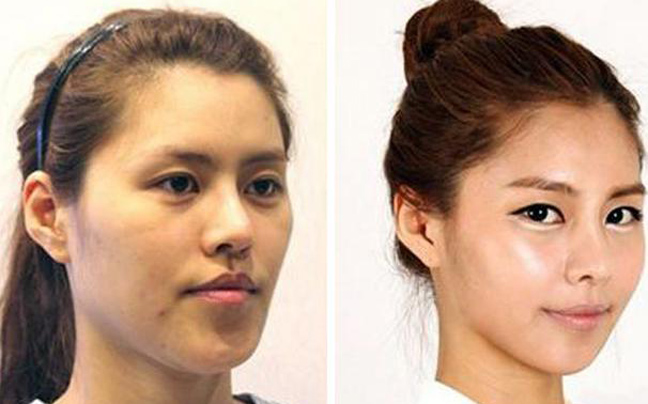 Κορεάτισσες πριν και μετά την πλαστική