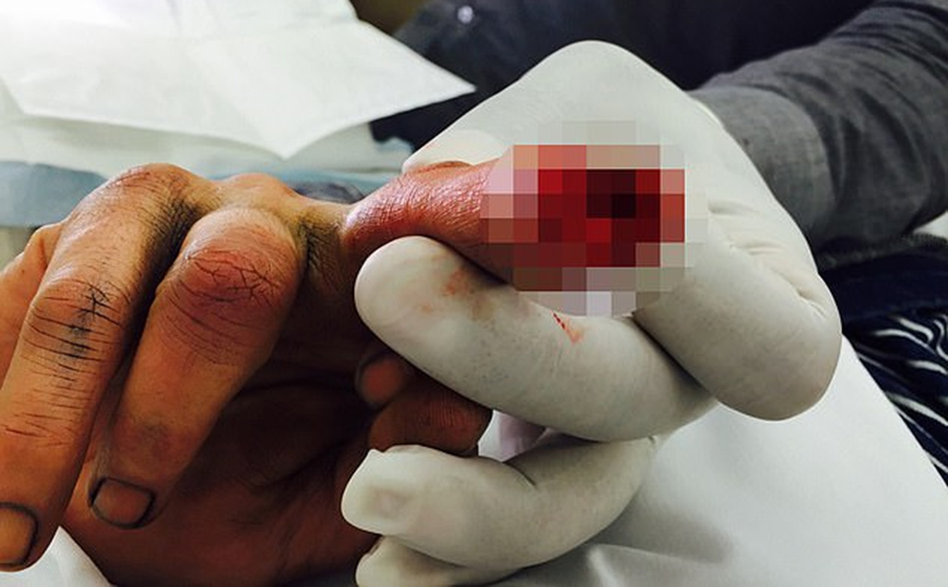 Το κομμένο δάχτυλο του Τζόνι Ντεπ Το κομμένο δάχτυλο του Τζόνι Ντεπ