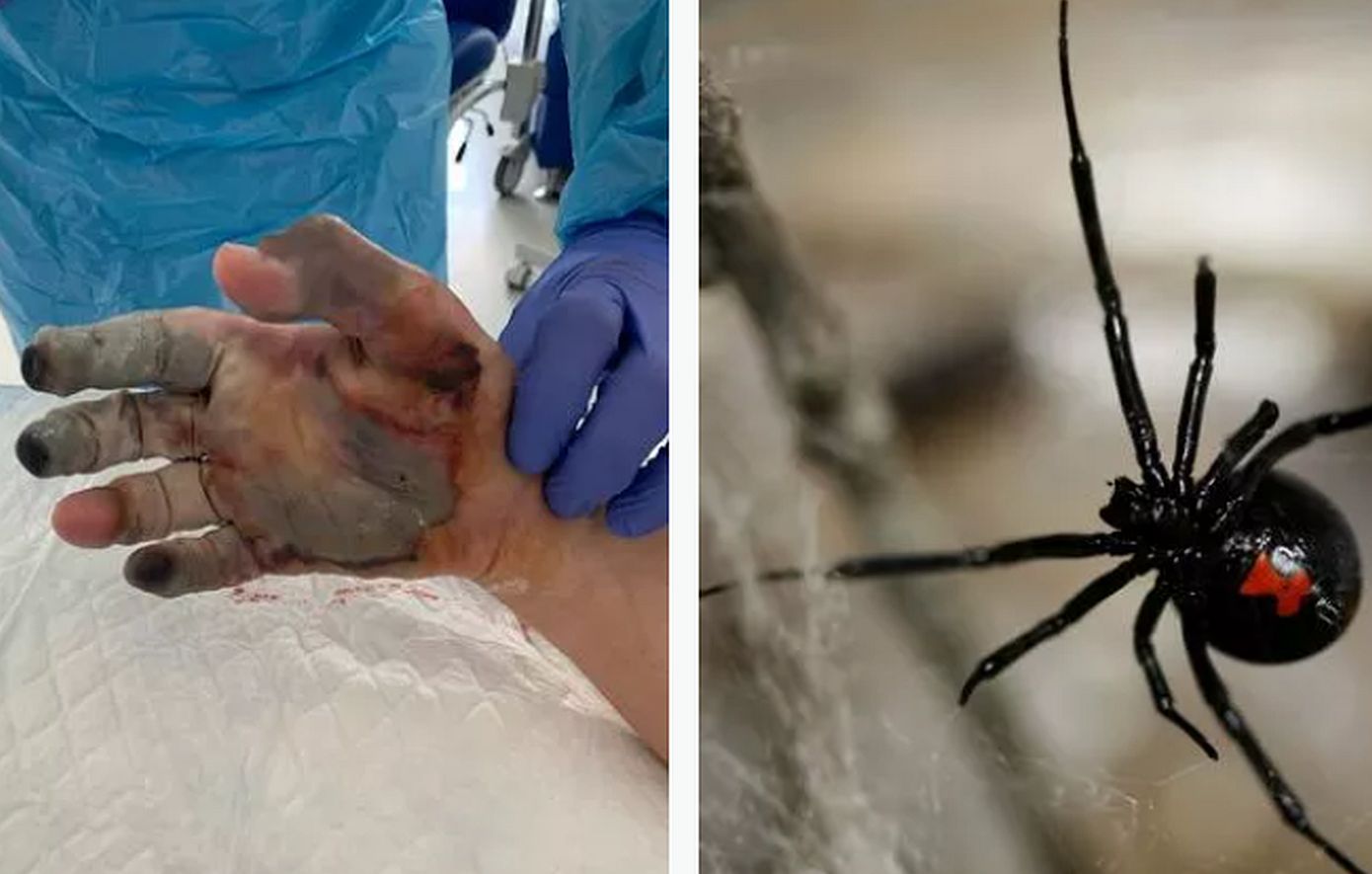 Τουρίστας που έχασε δάχτυλα από τσίμπημα αράχνης στην Ίμπιζα περιγράφει: «Ένιωσα ότι το χέρι μου είχε πάρει φωτιά»