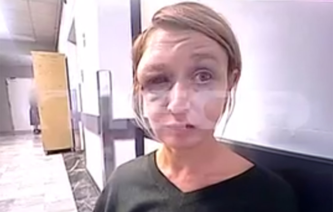 Σοκάρει η εικόνα της 40χρονης στο Κορωπί μετά τον ξυλοδαρμό της – «Τον αγαπώ, είμαστε μια κανονική οικογένεια»