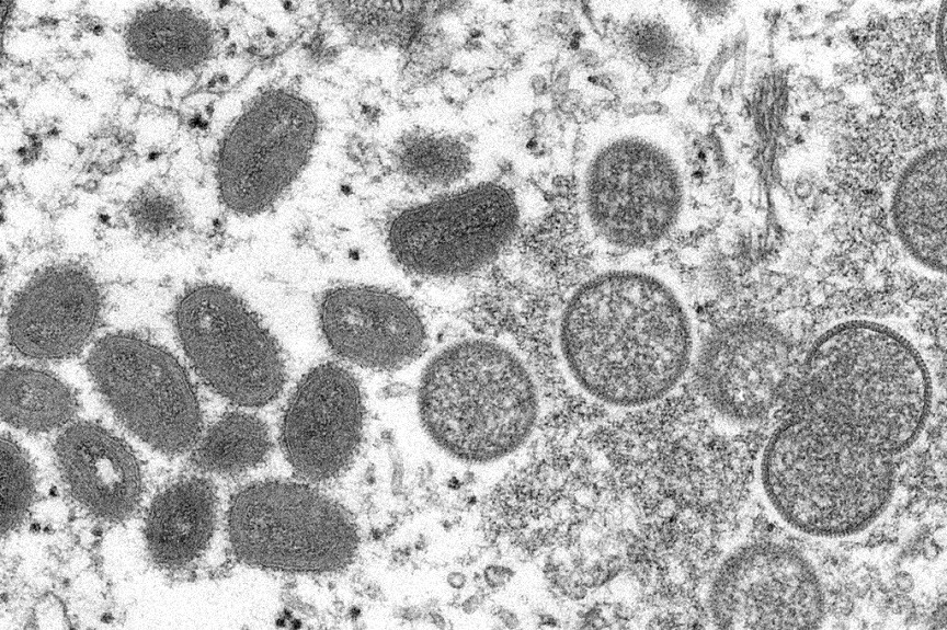 France : premier cas possible de monkeypox identifié