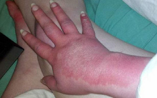 Samara-Rose-Ingraffia-suffers-from-erythromelalgia  (4)