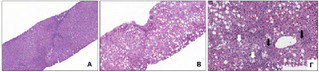 Εικόνα 1. Εικόνες μικροσκοπίου βιοψιών με βελόνα από: Α. Φυσιολογικό ήπαρ (μεγέθυνση x40), Β. Ήπαρ με απλή στεάτωση (οι λευκοί κύκλοι αντιστοιχούν στο λίπος μέσα στα ηπατοκύτταρα) (x40), Γ. Ήπαρ με στεατοηπατίτιδα, όπου επιπλέον της στεάτωσης υπάρχει ηπατοκυτταρική διόγκωση (λευκά βέλη) και φλεγμονή (μαύρα βέλη) (x100)